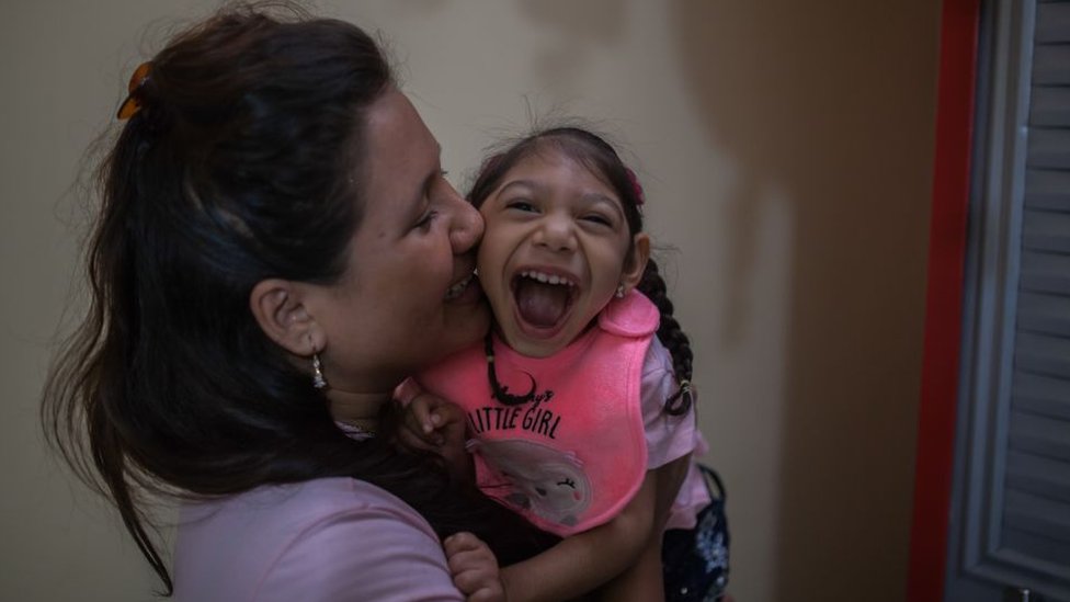 Niña con microcefalia