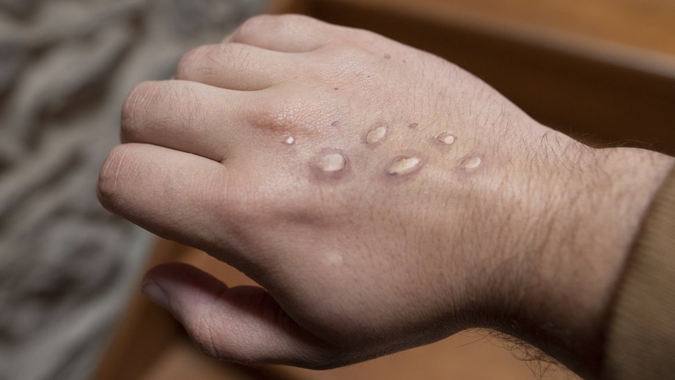 Monkeypox Skin hashes on the hand of a man