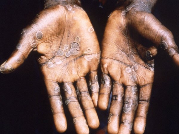 Los casos de viruela del mono en el mundo sobrepasaron los 26.000 según la OMS