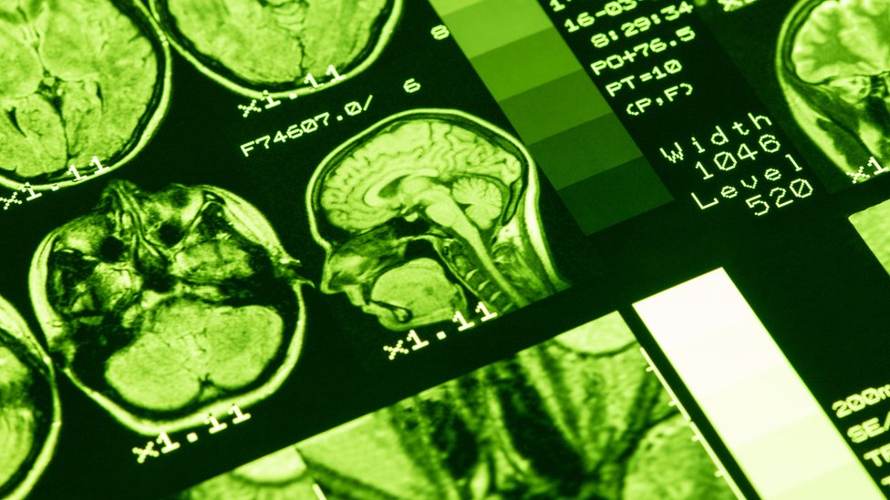 resonancia magnética del cerebro