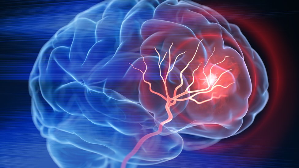 Ilustração mostra área acidentada no cérebro, representando ocorrência de AVC