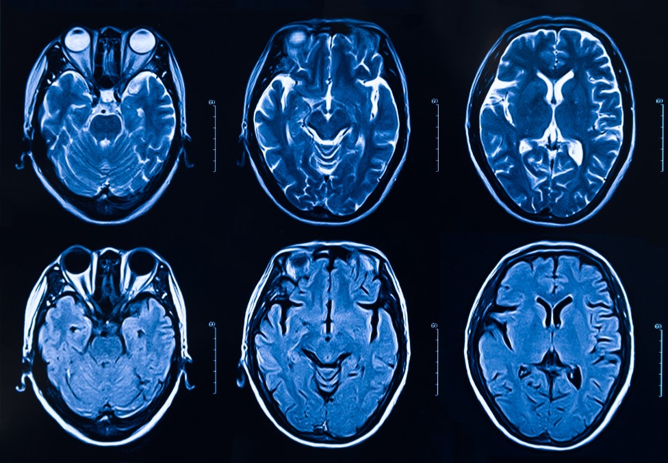 Imagen de resonancia magnética del cerebro