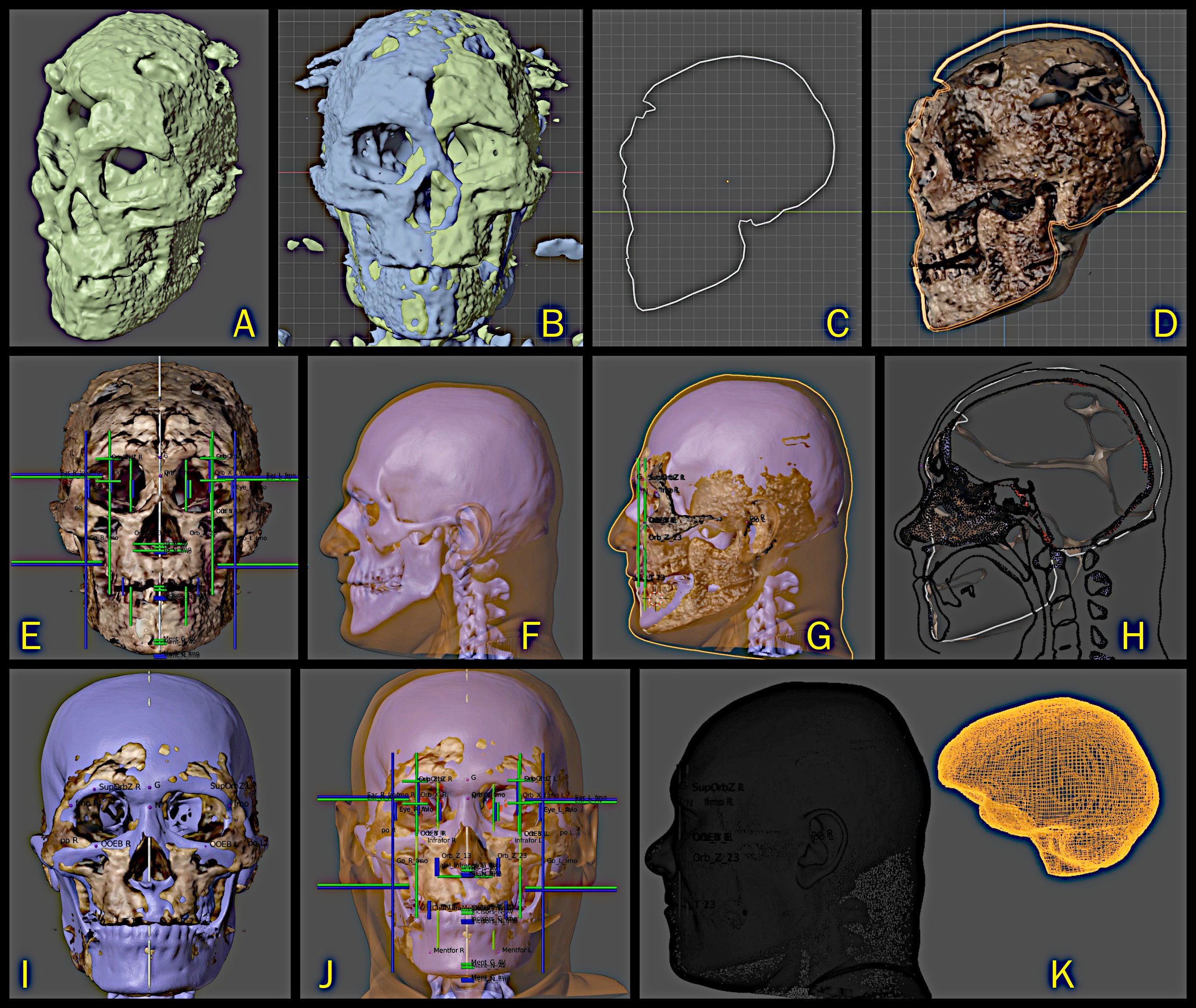 Imágenes de reconstrucción craneal