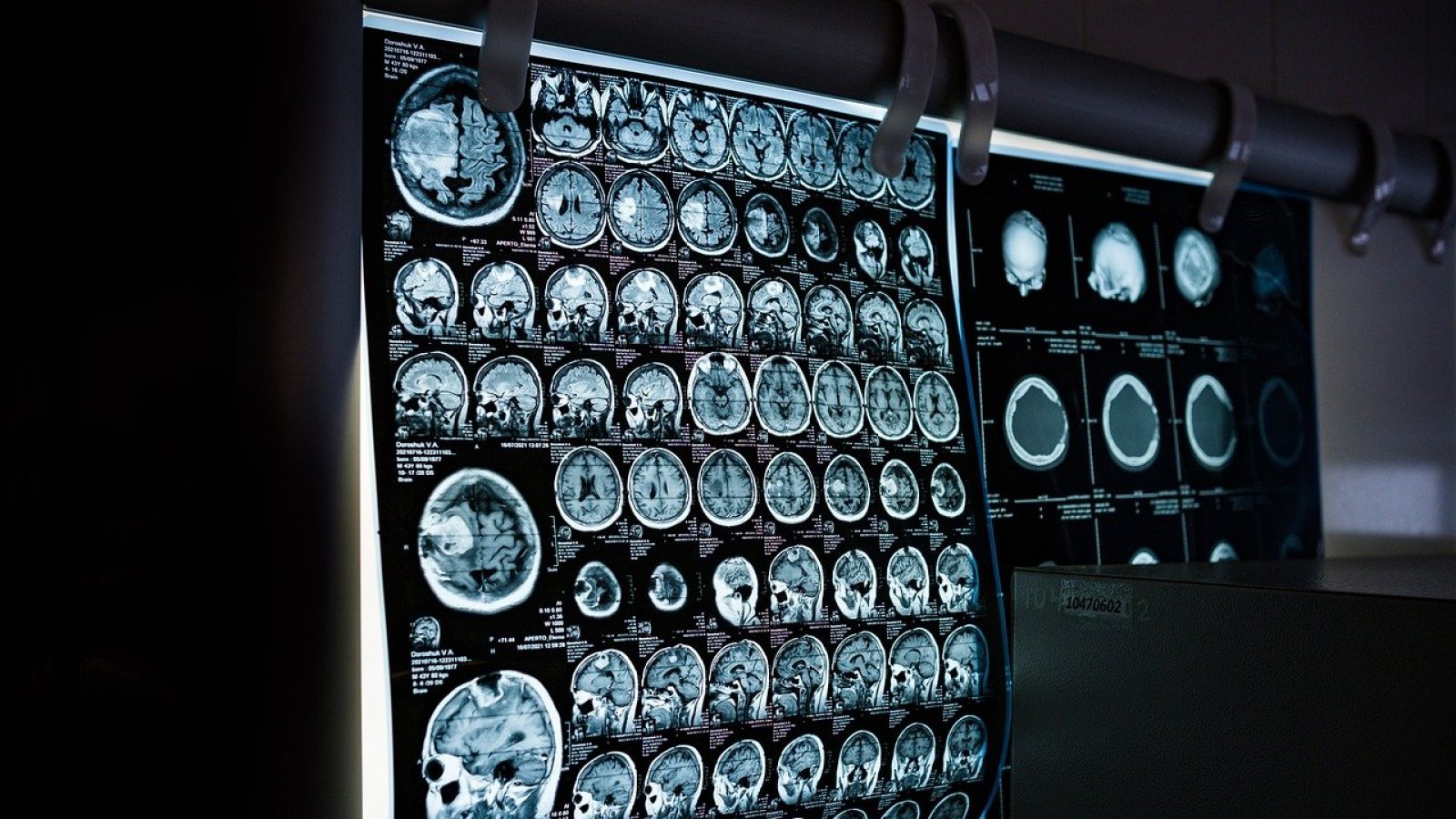 Imágenes de una tomografía cerebral