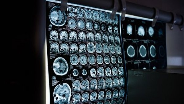 Imágenes de una tomografía cerebral