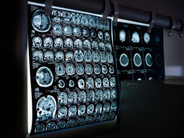 Imágenes de una tomografía cerebral