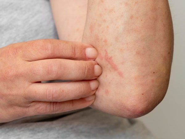 Persona tocándose el brazo, el que tiene marcas rojas.