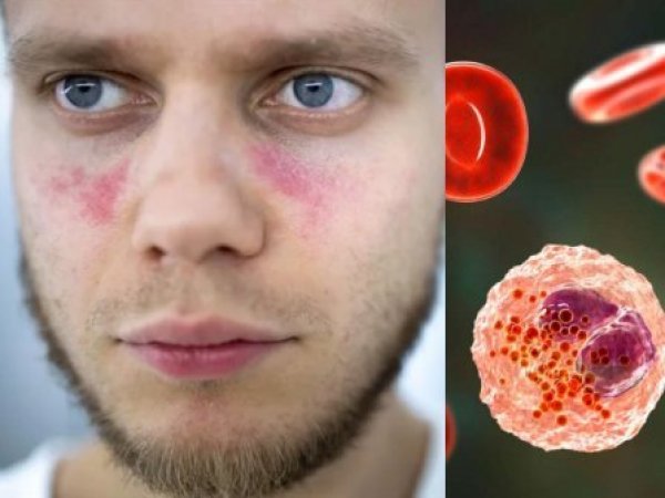 Persona que padece lupus