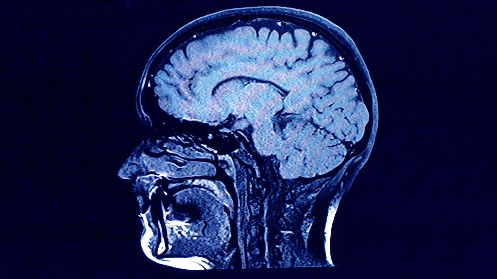 ¿Producimos nuevas neuronas en la vida adulta? El pico de la bomba ha ayudado a proporcionar respuestas.
