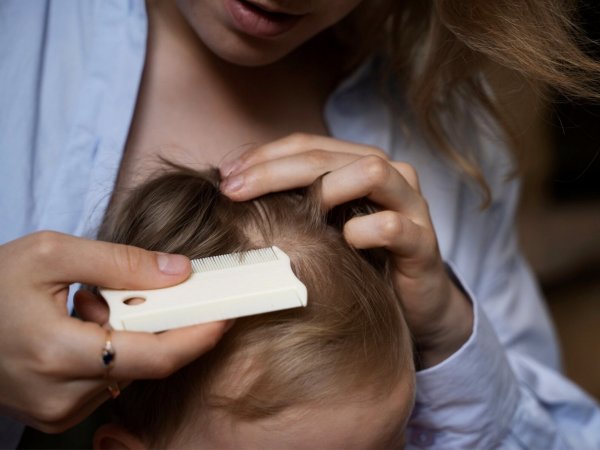 Piojos. Qué significa soñar con piojos.
