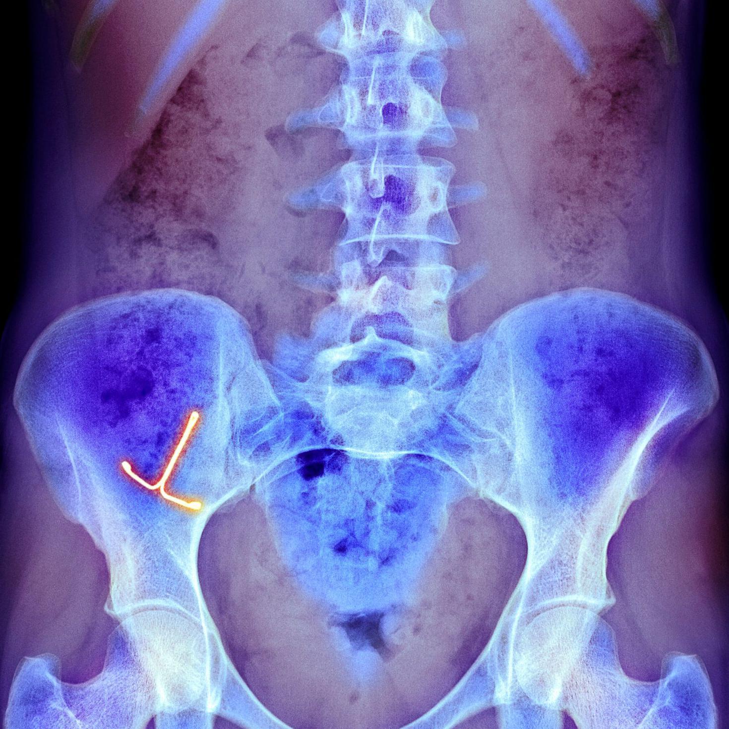 Una radiografía muestra un dispositivo anticonceptivo intrauterino en el vientre de una mujer
