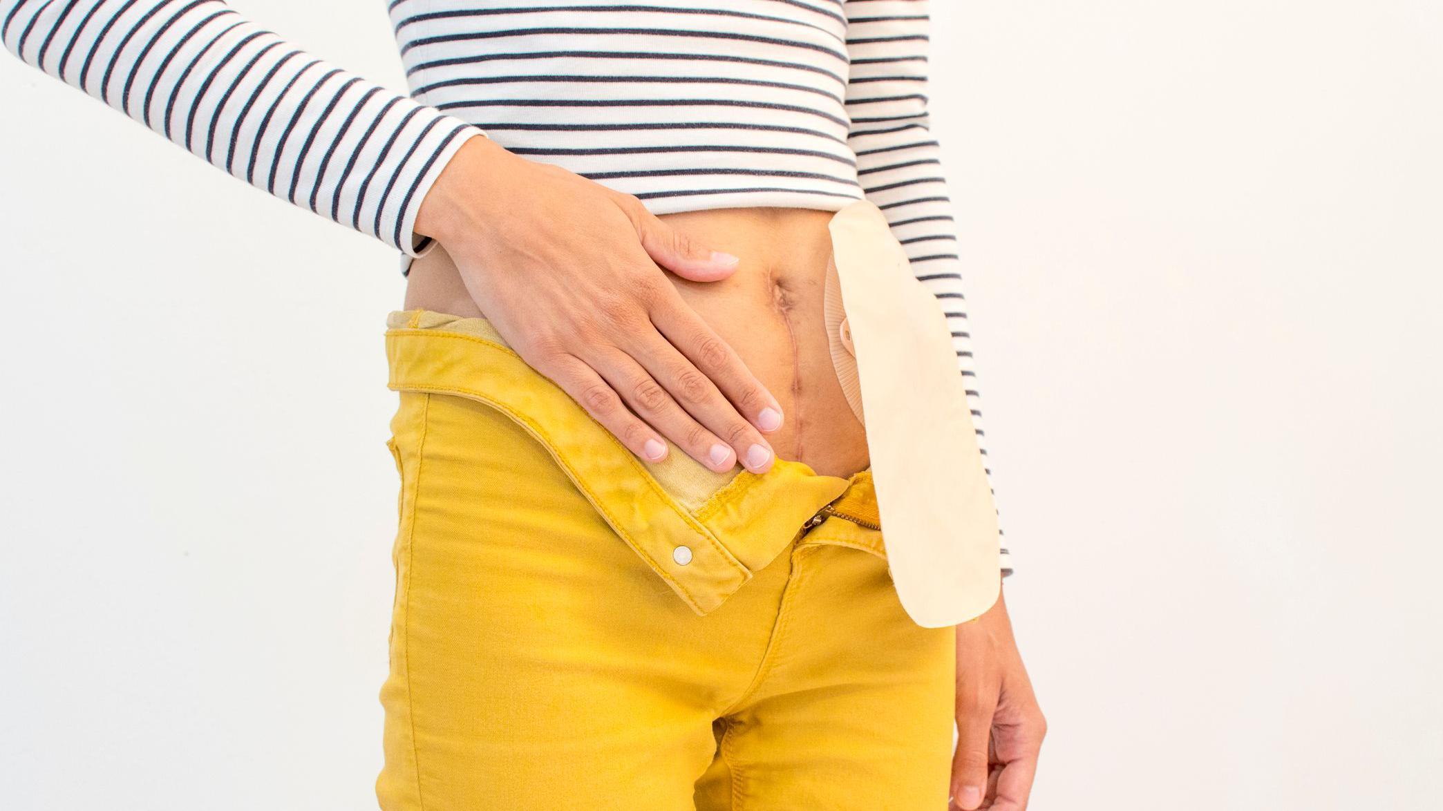 Mujer con colostomía