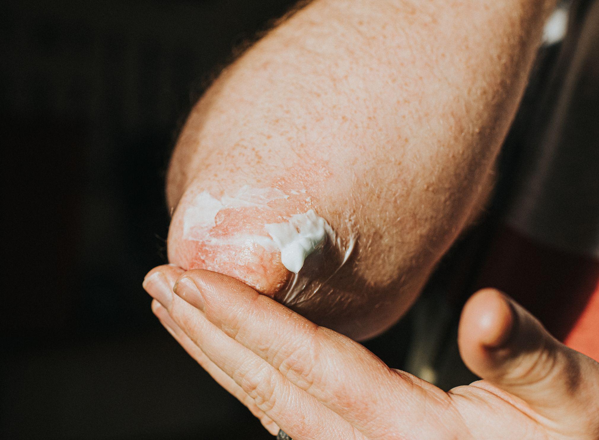 alguien se aplica una crema para la picazón en el codo 