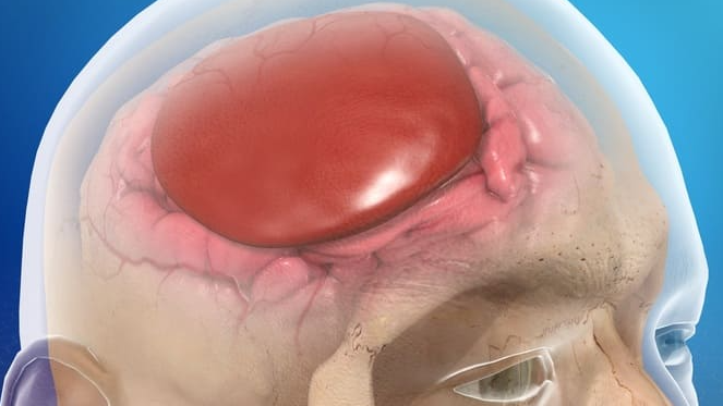 Hematoma subdural