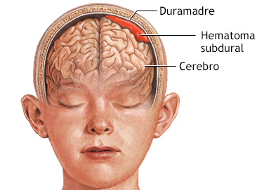 Hematoma subdural