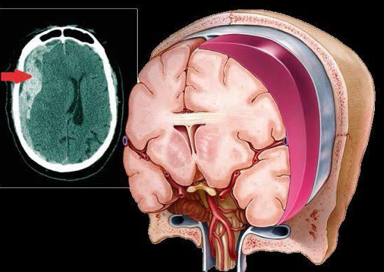 Hematoma subdural.