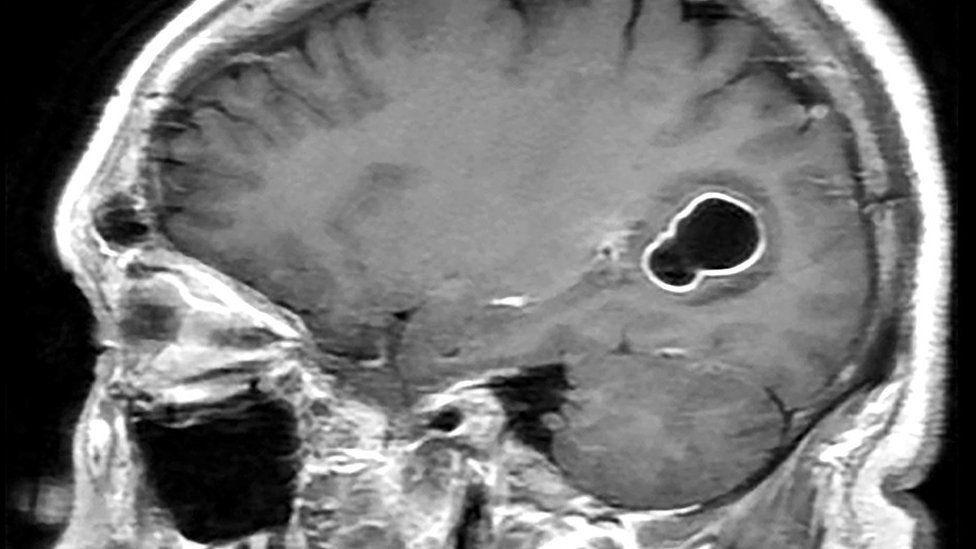 Esta imagen de resonancia magnética sagital (lateral) ponderada en T1 de la cabeza con realce de contraste muestra una lesión quística en la región temporal-occipital del cerebro. El quiste es oscuro y la baja señal circundante es el edema inflamatorio. Hay realce periférico a lo largo de la pared del quiste compatible con infección activa. Esta es una lesión relacionada con la infección por huevos de la tenia del cerdo.