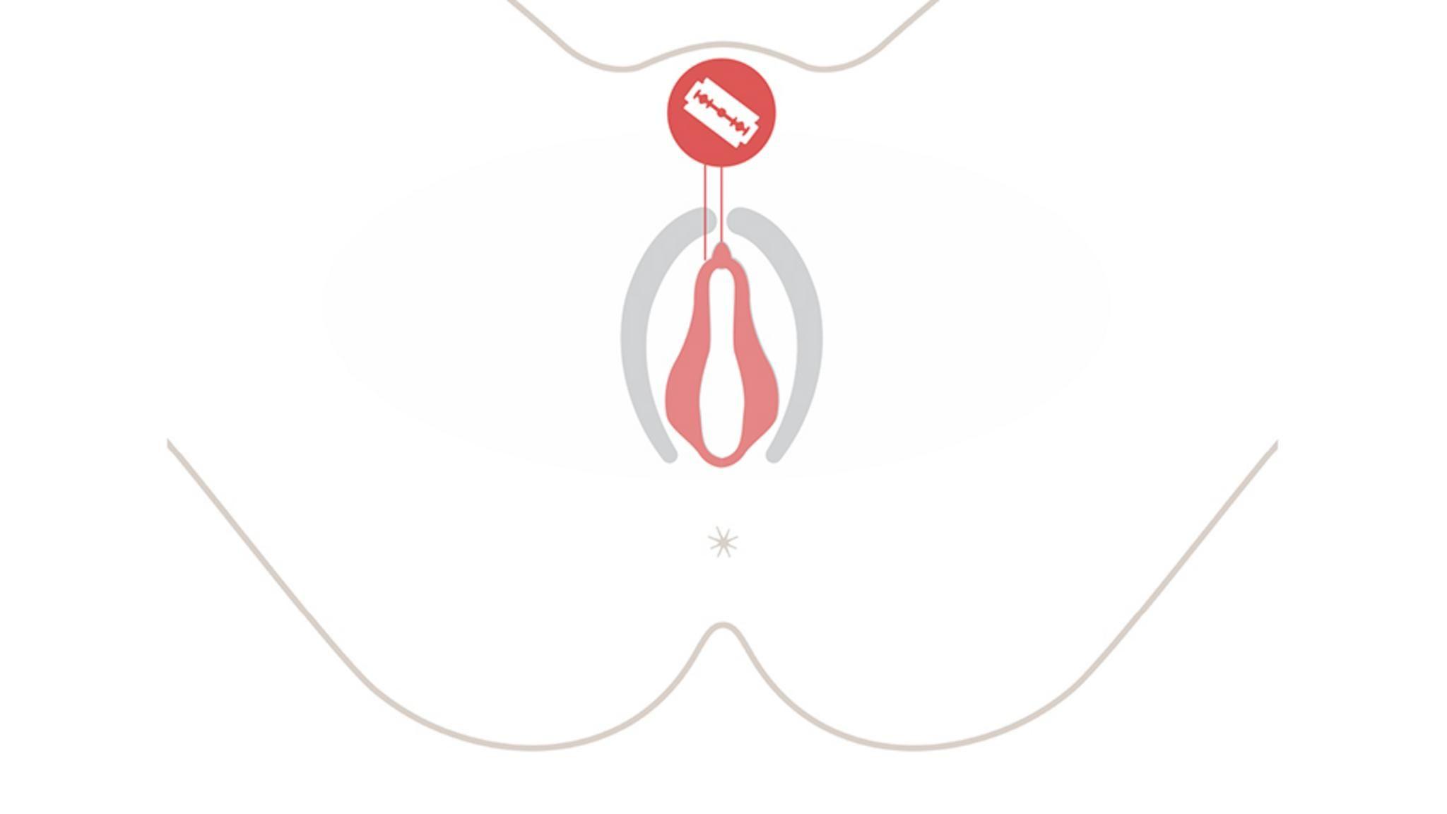 Gráfico sobre una escisión genital femenina.