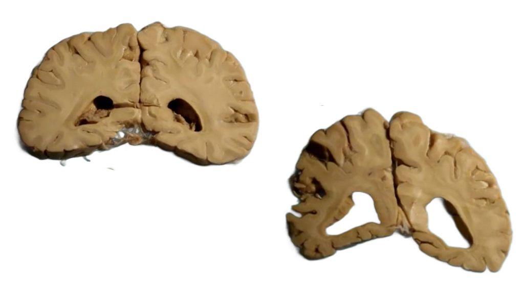 Izq. cerebro sano de monja de 90 años; der. cerebro de monja de 89 años con Alzheimer