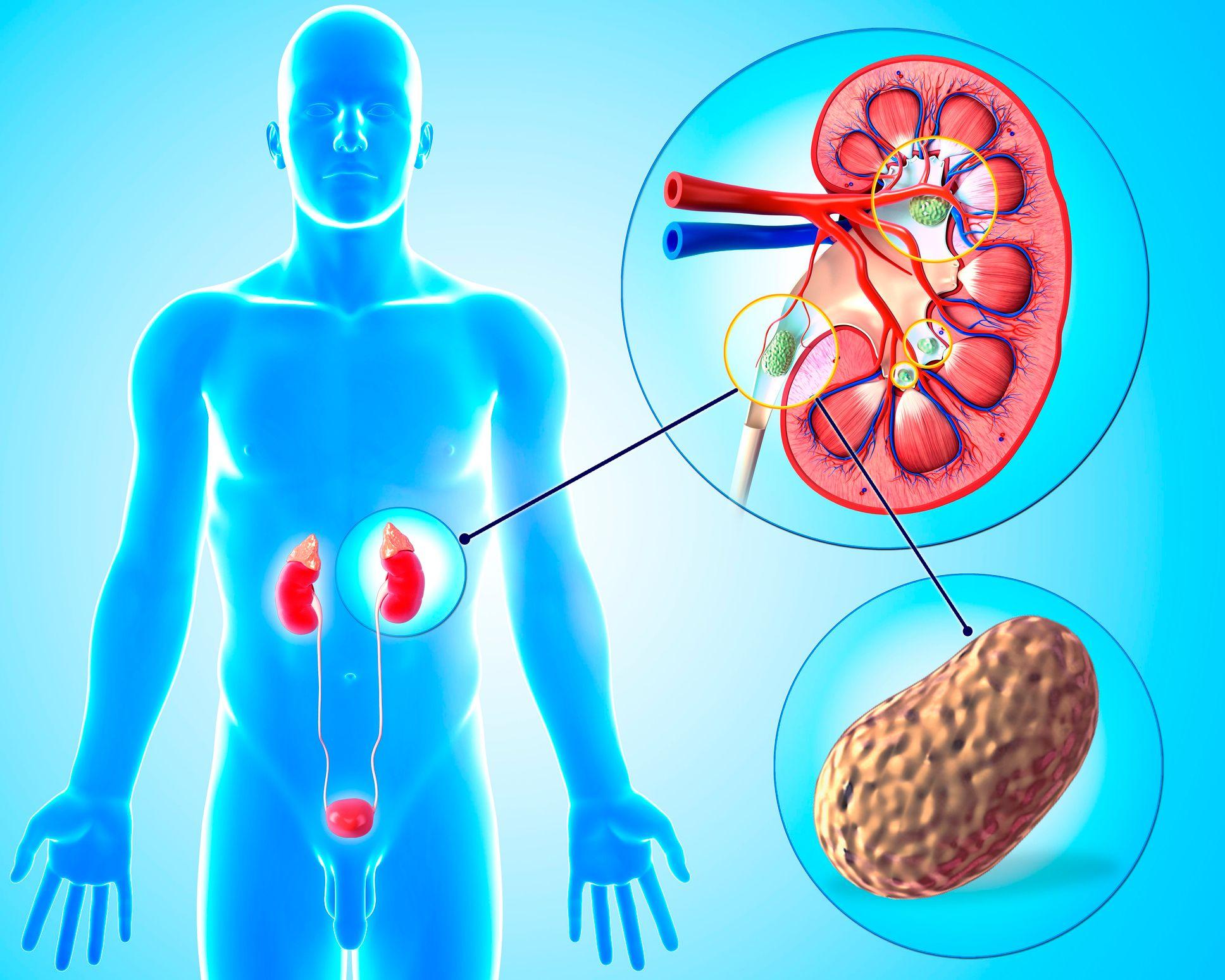 Gráfico muestra la formación de un cálculo renal
