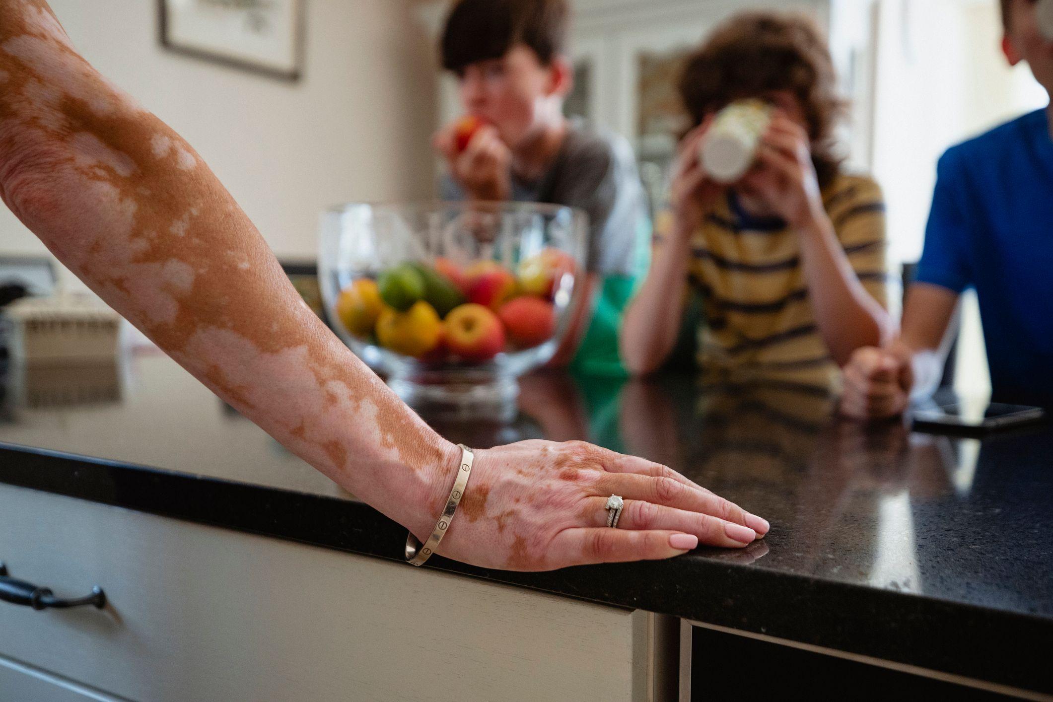 La mano de una mujer con despigmentación