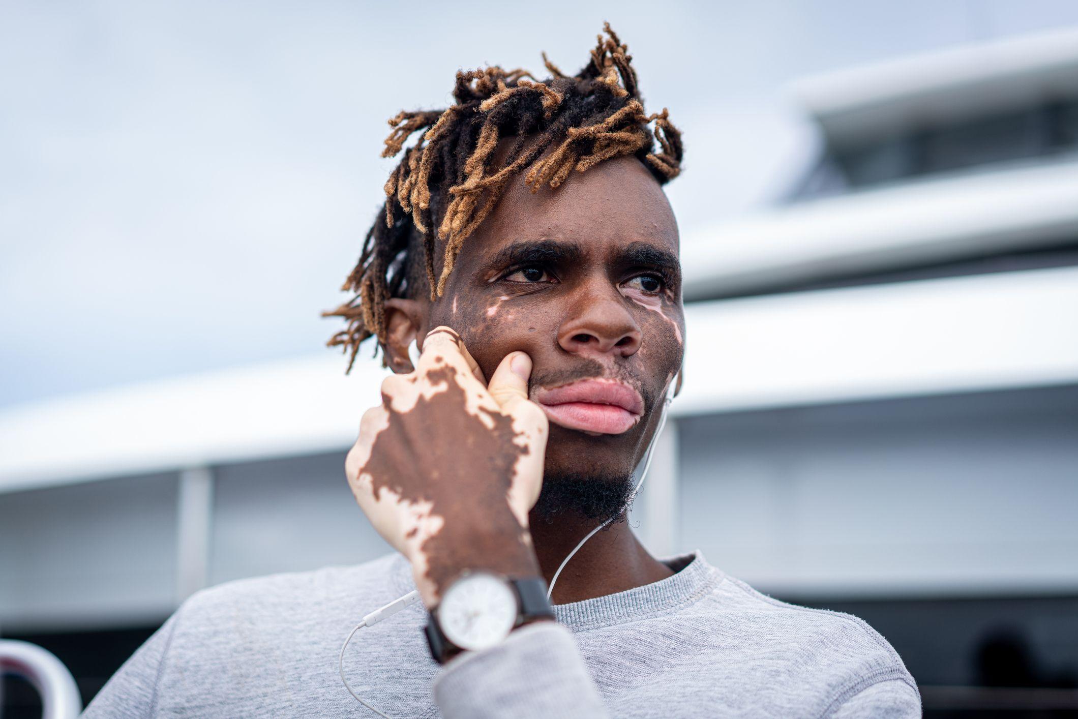 Un hombre negro con vitiligo