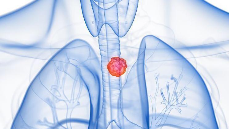 Cáncer de esofago