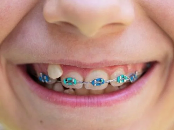 Ortodoncia preventiva