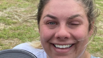 Tracy Otto sonríe y muestra su ojo izquierdo que perdió en un ataque violento.