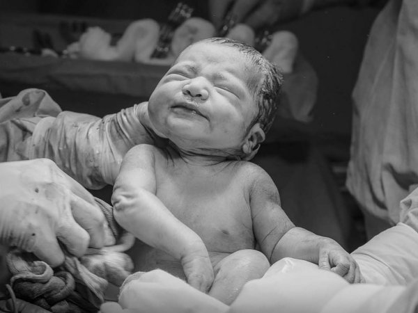 Bebé recién nacido con partículas de microplásticos en la placenta.
