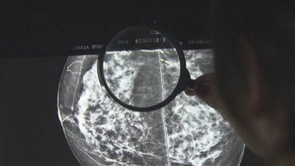 quimio-cebrero-efecto-colaterales-quimioterapia