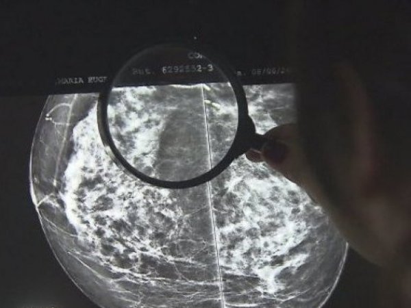 quimio-cebrero-efecto-colaterales-quimioterapia