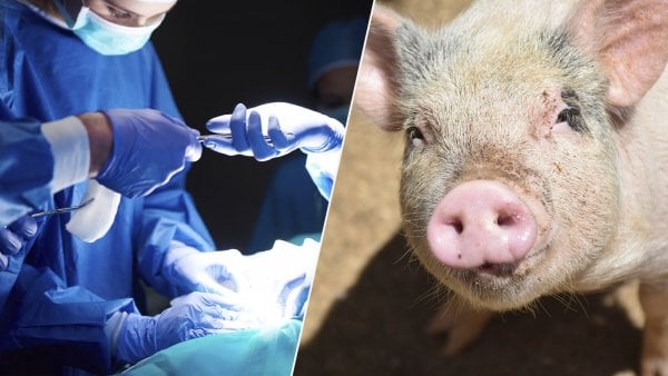 Trasplante de hígado de cerdo a ser humano.