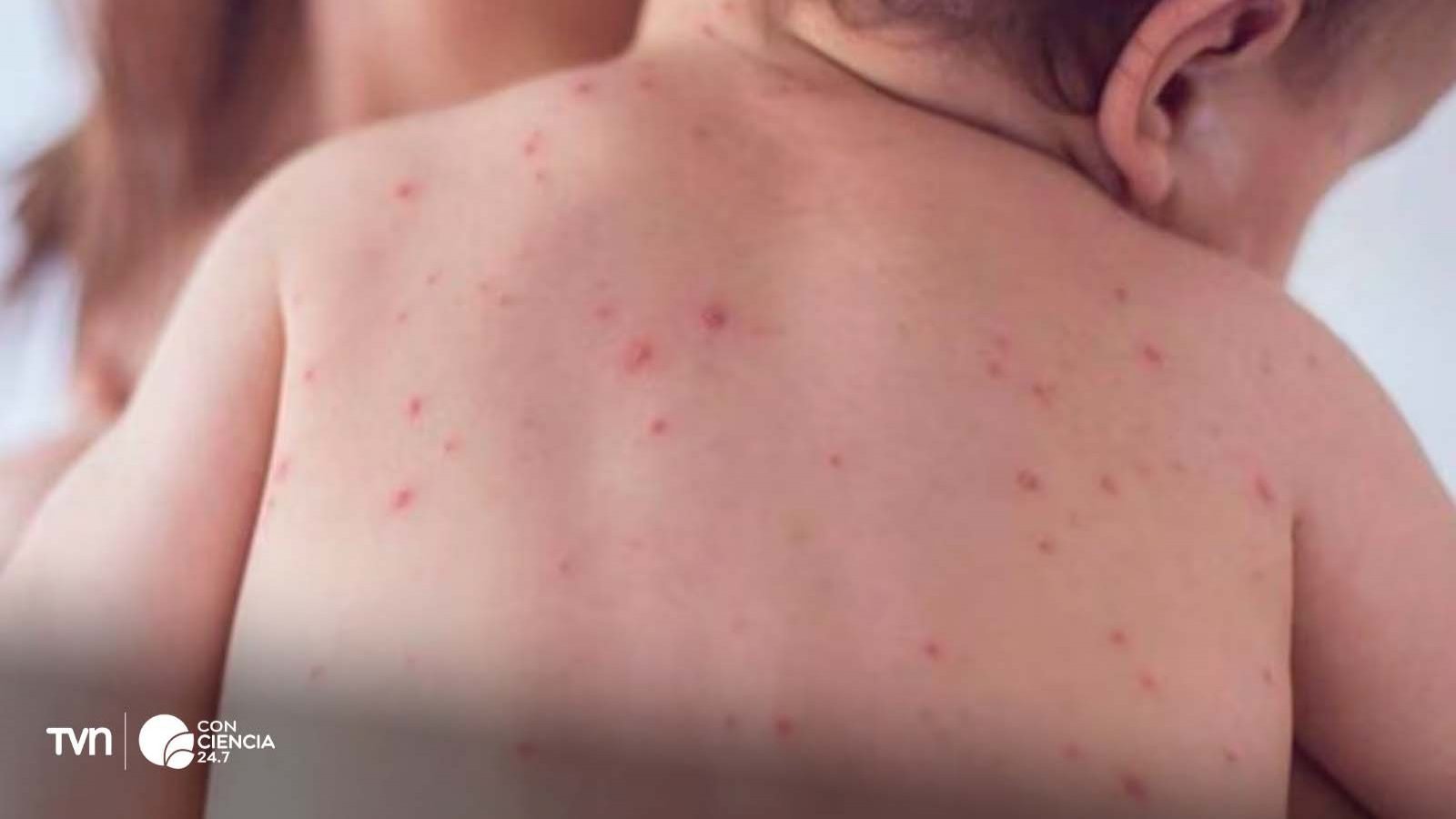 Niño siendo vacunado contra el sarampión en un centro de salud en Chile.