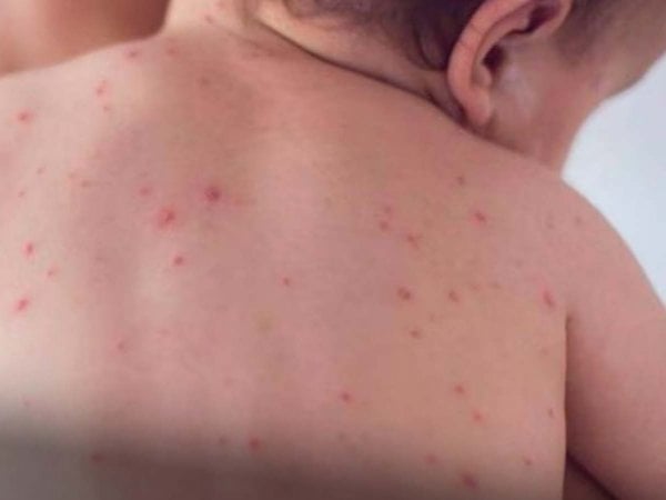 Niño siendo vacunado contra el sarampión en un centro de salud en Chile.