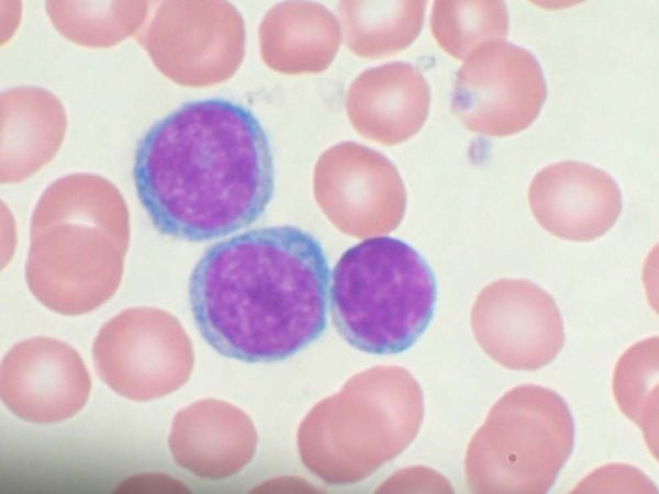 Ensayo clínico en Reino Unido marca hito en tratamiento sin quimioterapia para la leucemia linfocítica crónica.