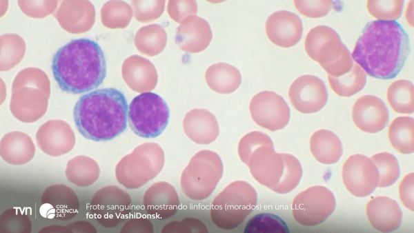 Ensayo clínico en Reino Unido marca hito en tratamiento sin quimioterapia para la leucemia linfocítica crónica.