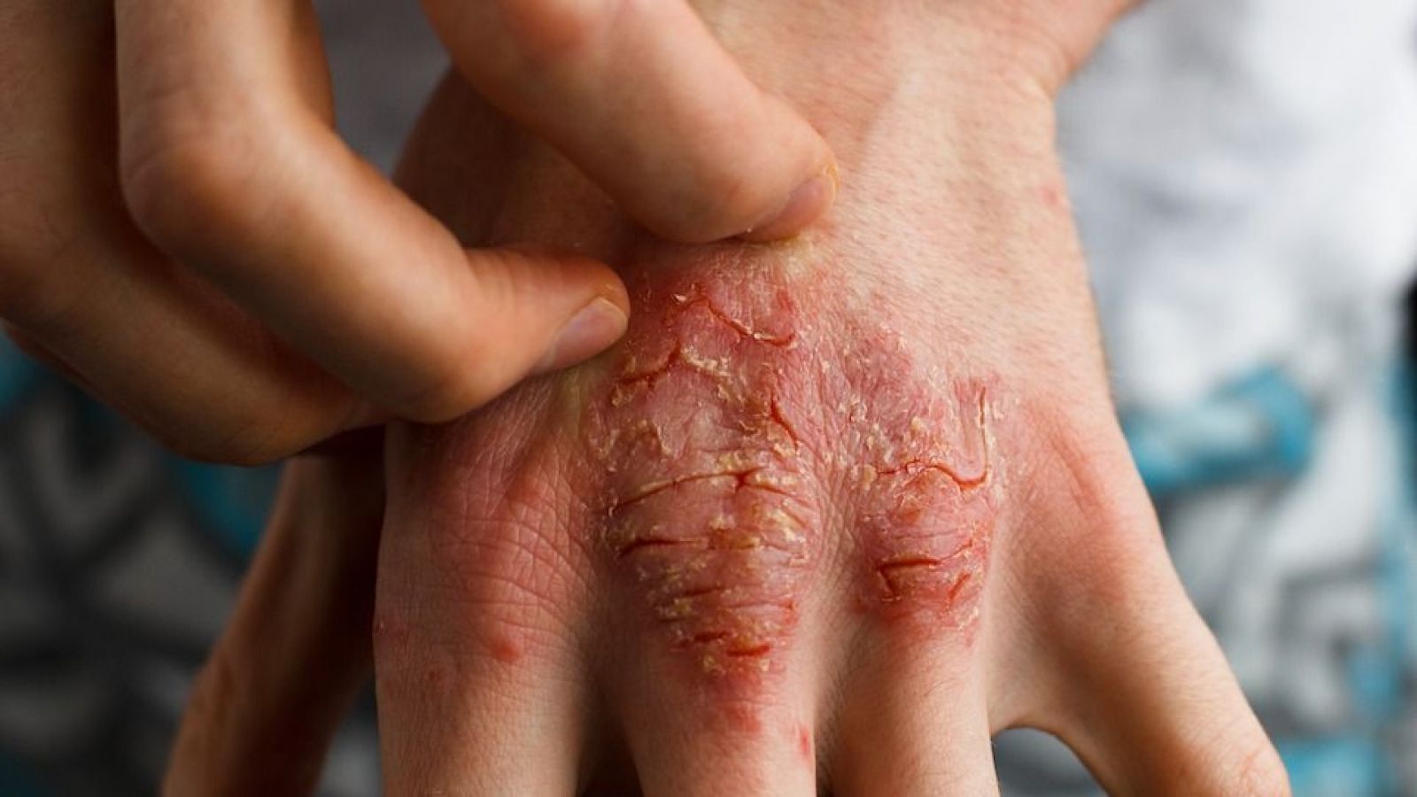 Dermatitis Atópica: los costos económicos y psicológicos de una enfermedad sin cobertura en Chile