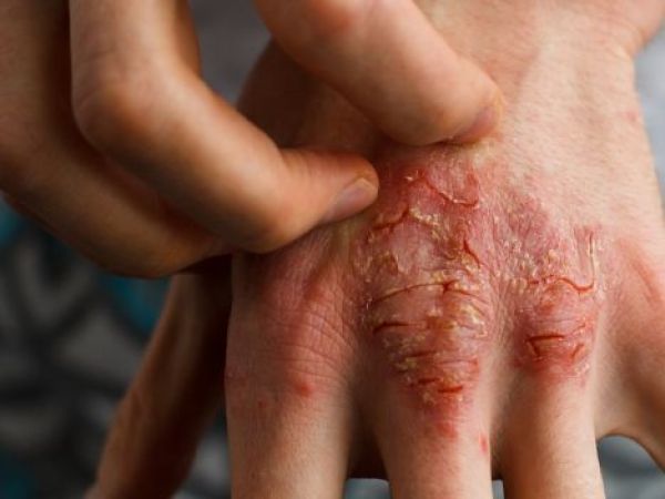 Dermatitis Atópica: los costos económicos y psicológicos de una enfermedad sin cobertura en Chile