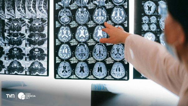 Resonancia cerebral utilizada en estudio sobre el impacto de la pandemia en la salud del cerebro.