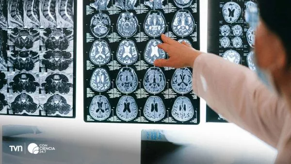 Resonancia cerebral utilizada en estudio sobre el impacto de la pandemia en la salud del cerebro.