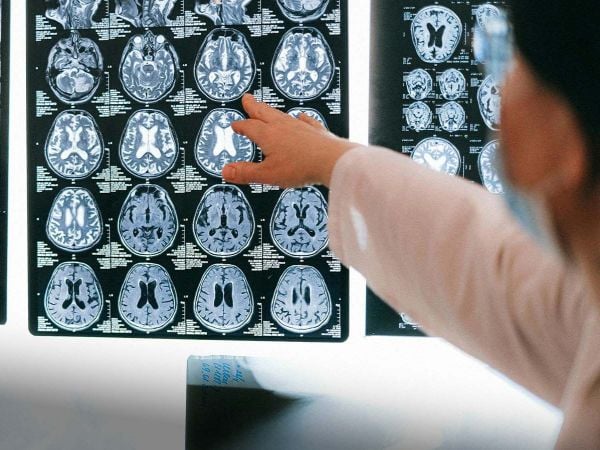 Resonancia cerebral utilizada en estudio sobre el impacto de la pandemia en la salud del cerebro.