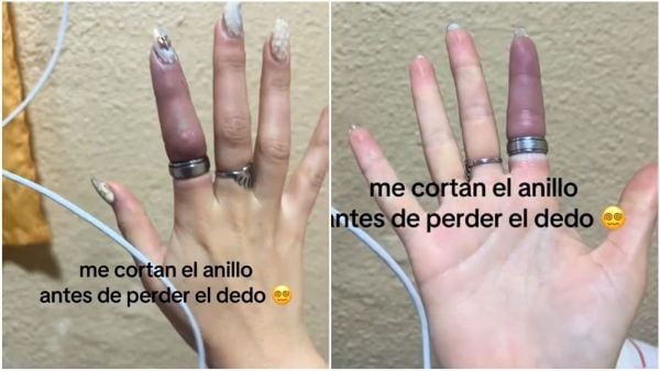 Anillo queda atrapado en dedo de mujer argentina