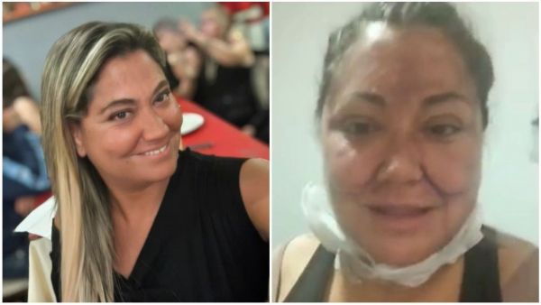 Denisse Campos tras procedimientos estéticos