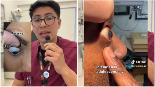 Tecnólogo médico advierte riesgos de frotarse los ojos