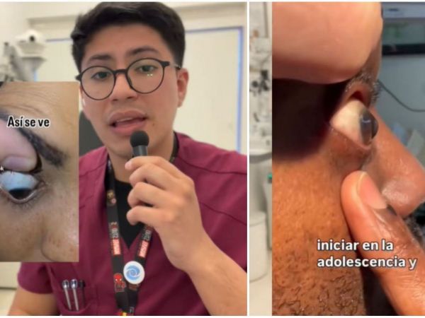 Tecnólogo médico advierte riesgos de frotarse los ojos