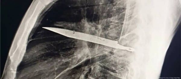 CUCHILLO EN EL TORAX