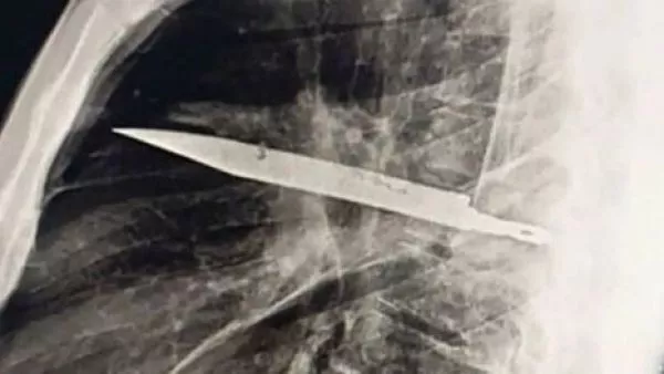 CUCHILLO EN EL TORAX