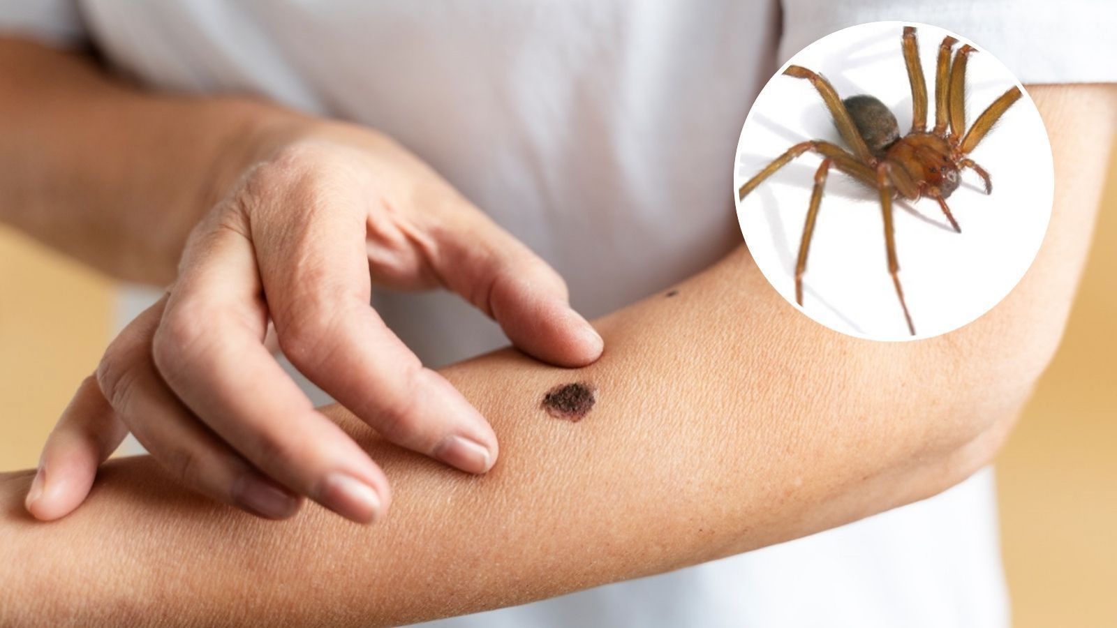 Picadura araña de rincón