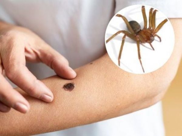 Picadura araña de rincón